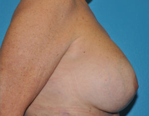 Augmentation Mastopexy