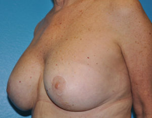 Augmentation Mastopexy