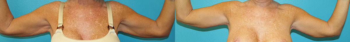 Arm Lift: before on the left and after on the right, from the New Leaf Plastic Surgery patient gallery