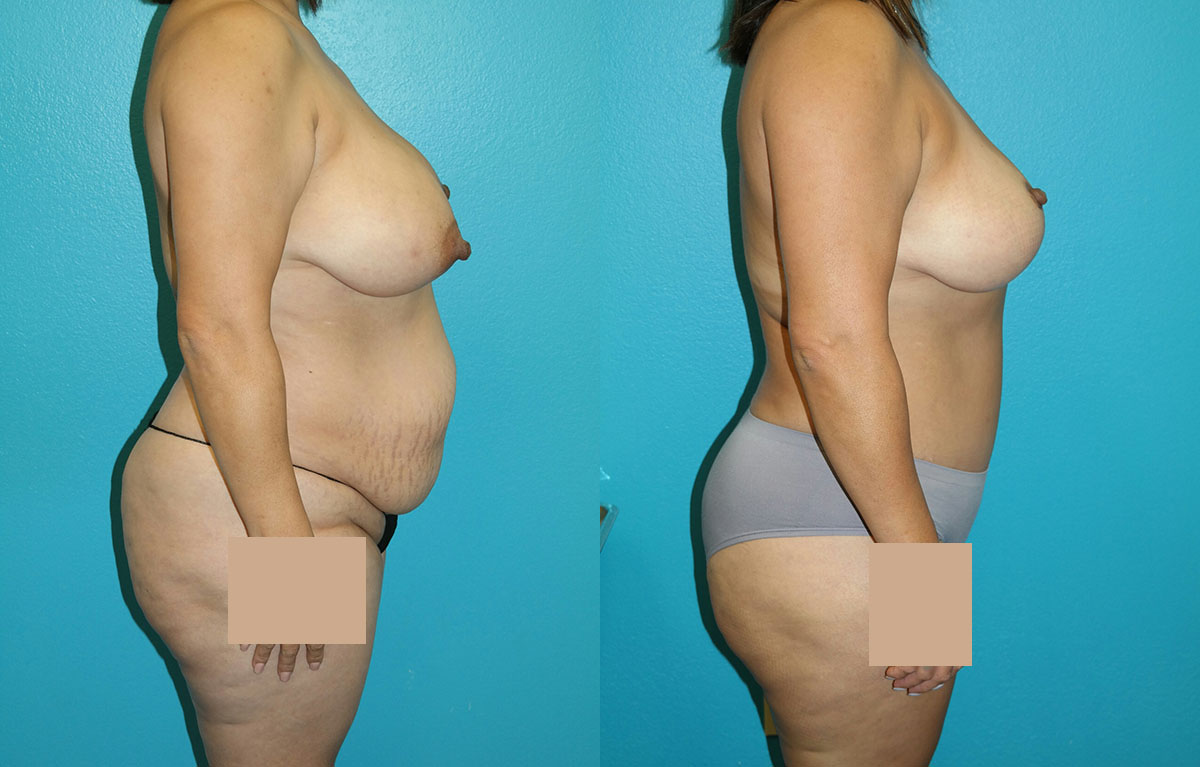 Mommy Makeover
