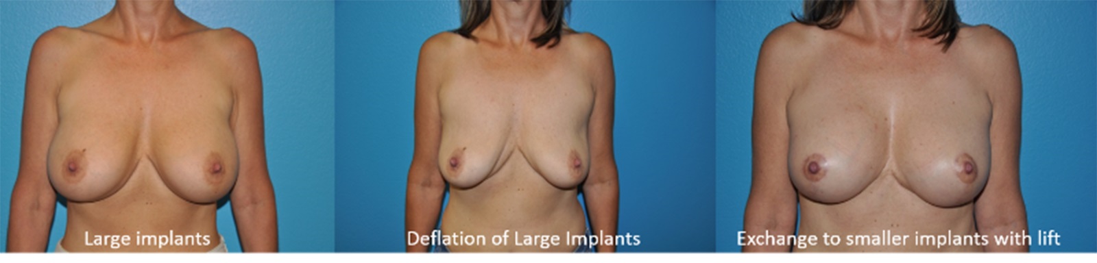 breast-revisions